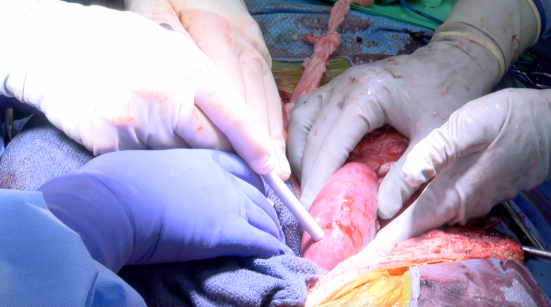 Pig Kidney Transplant