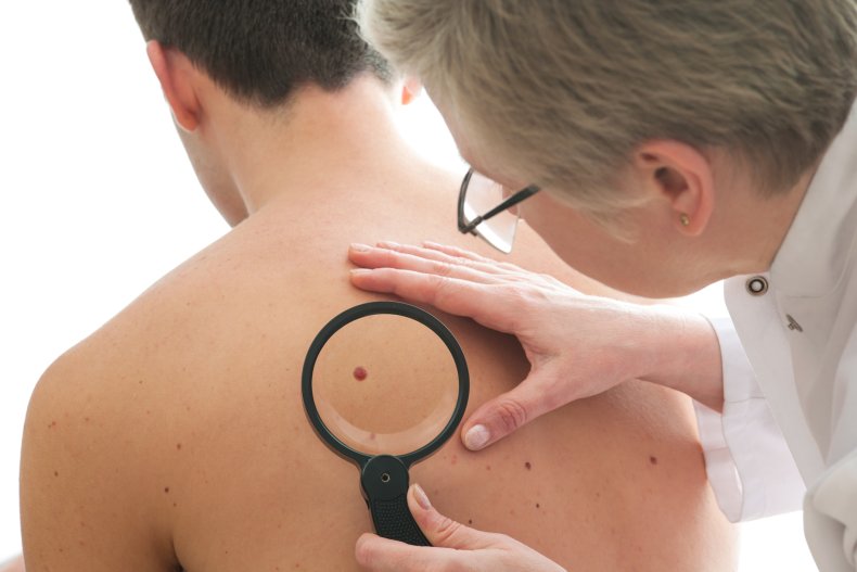 skin cancer doctor mole