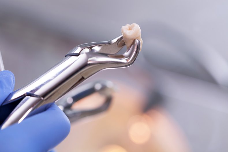 Extracted Tooth