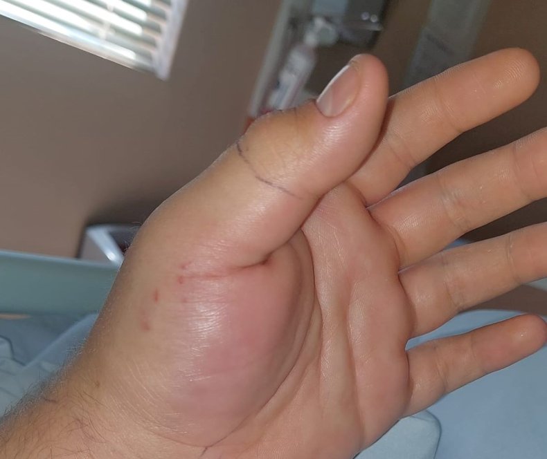 Snake bite