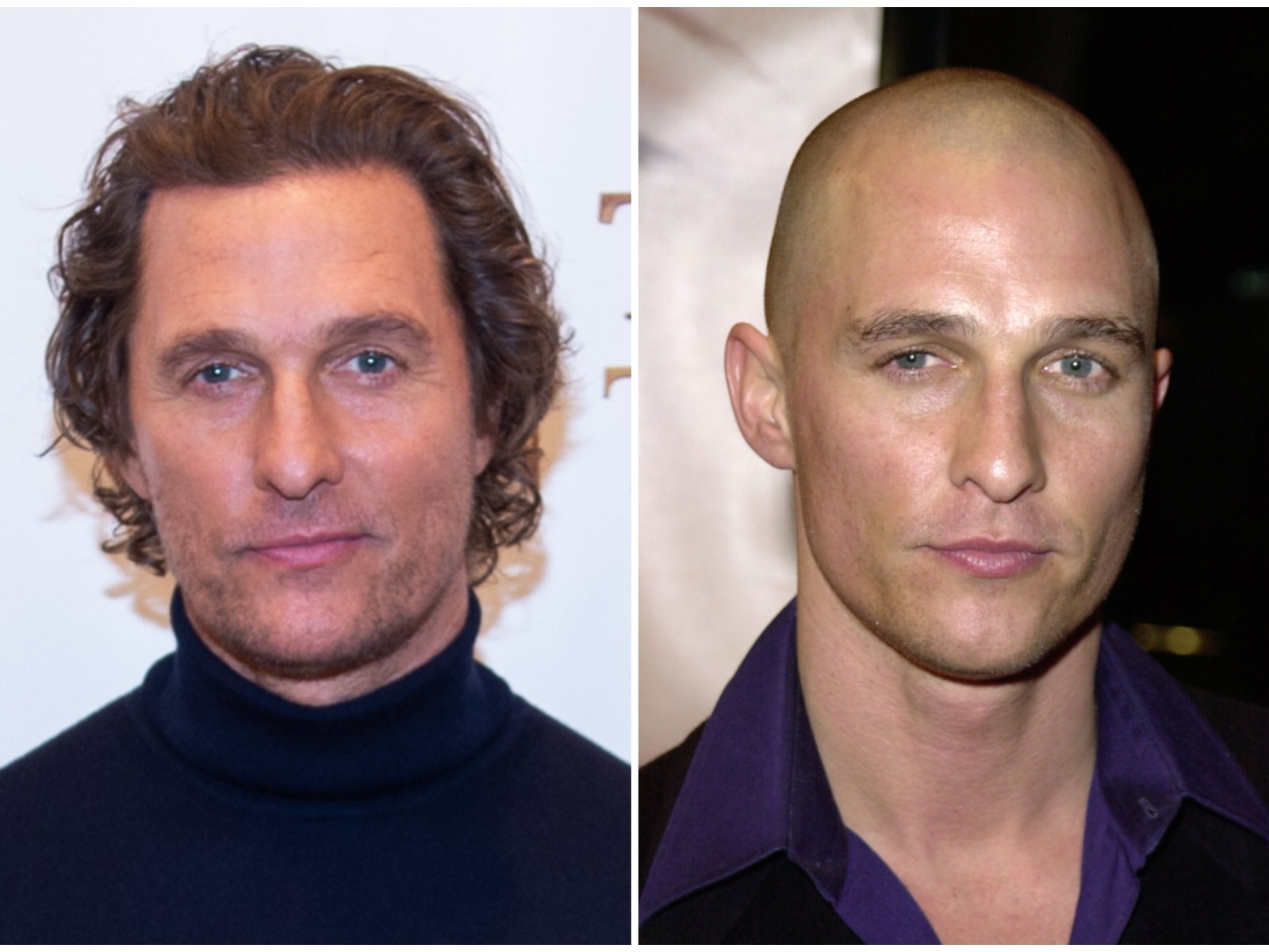 Matthew McConaughey Clears Up Hair Transplant Rumor After Battling Baldness