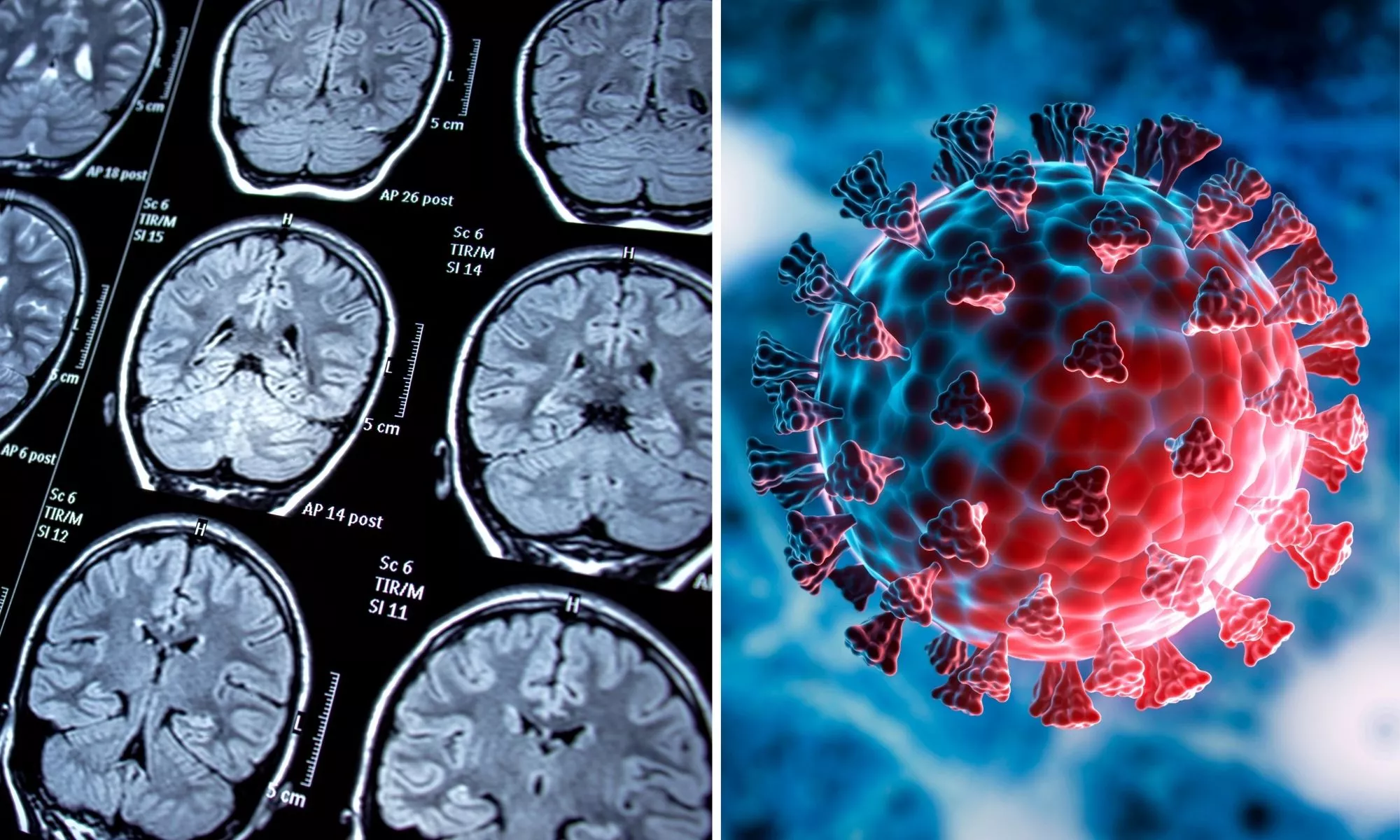 Brain Changes Caused by COVID Could Help Understand Effect on Smell, Memory - Vimarsana News