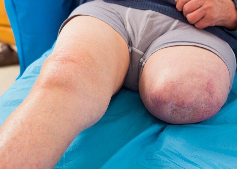 amputated leg