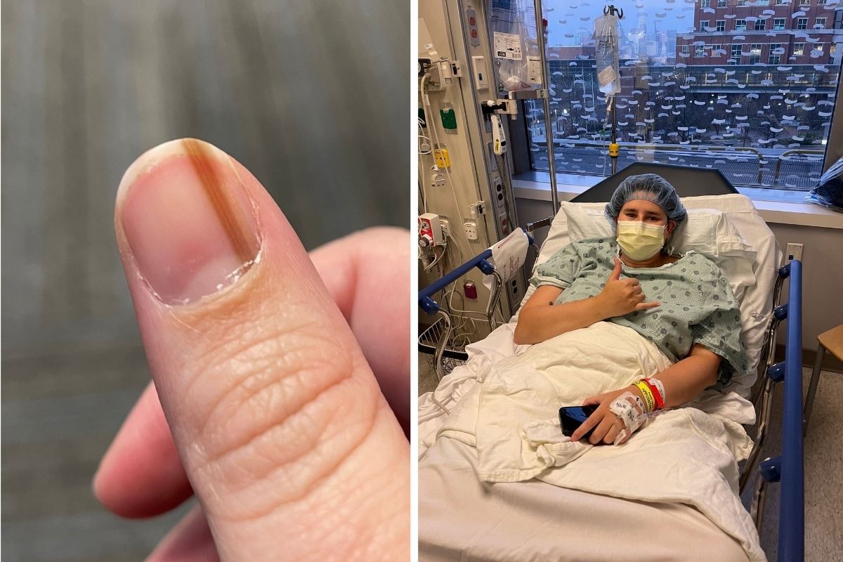 Cool Streak' on Teen's Thumb Diagnosed As Rare Cancer 10 Years Later