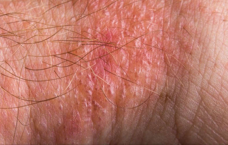 Poison ivy rash seen on human skin.