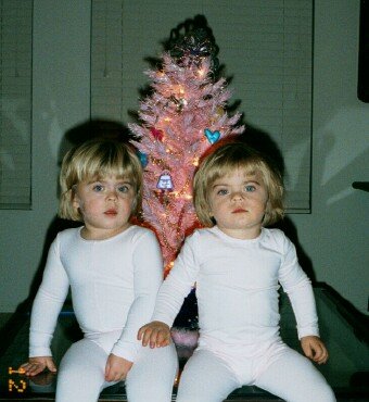 Twins Abigail and Amelia both have TSC Twins Abigail and Amelia both have TSC