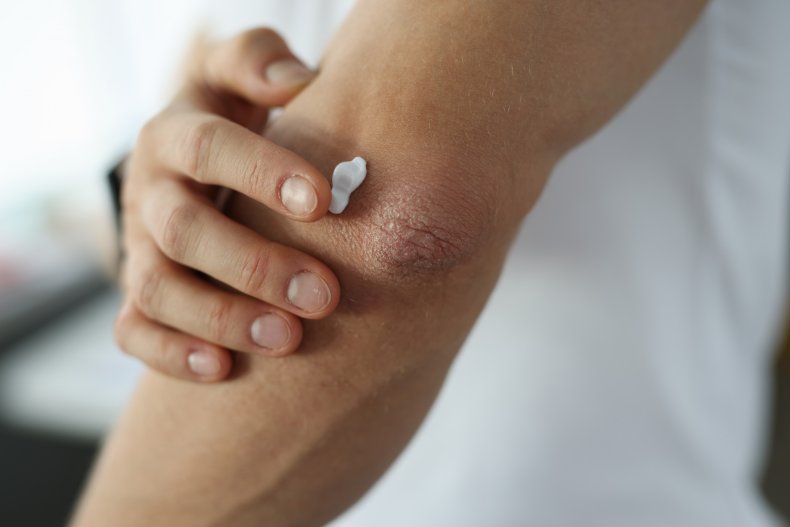 Person applying cream to elbow.