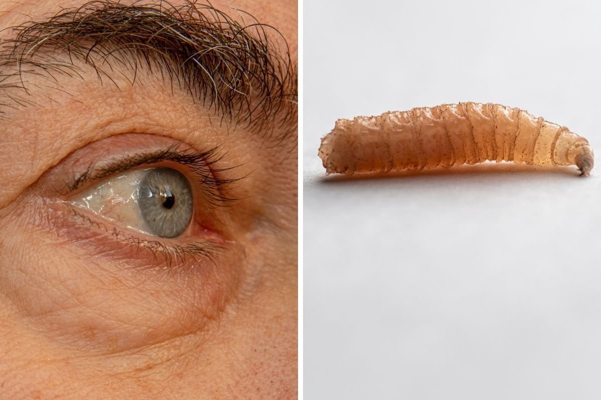 Man's Eye Infested With Over a Dozen Fly Maggots While Gardening