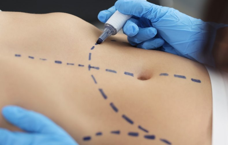 Tummy tuck