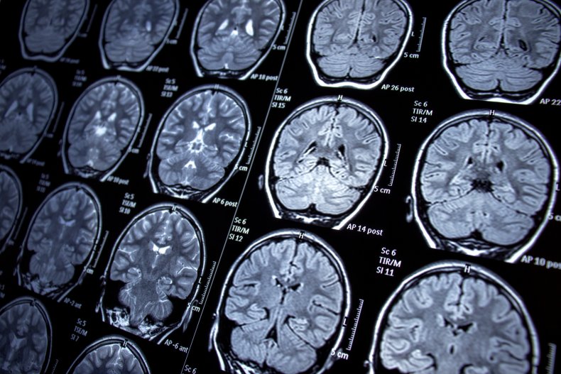 Brain scan results