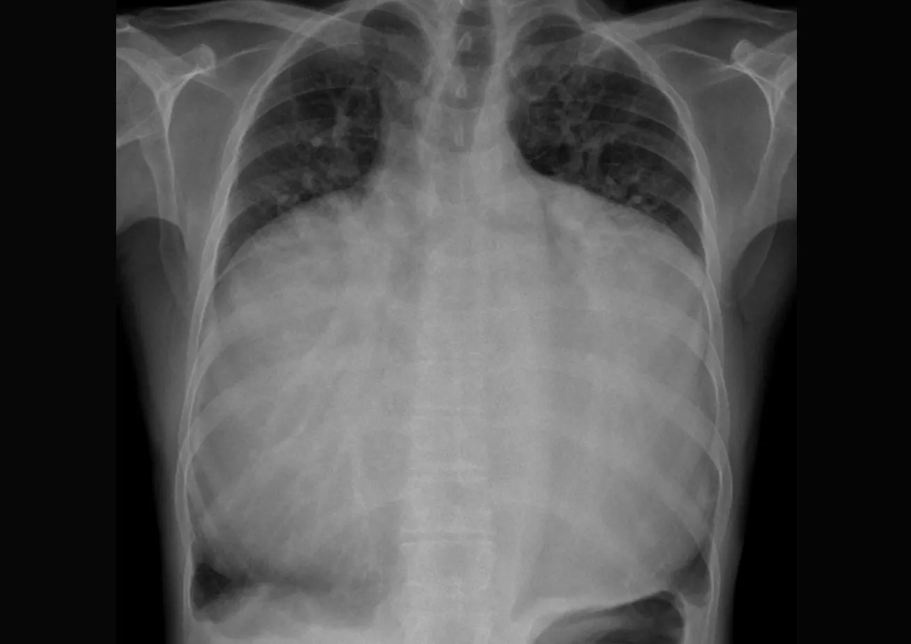 Man's Heart Filled His Entire Chest in Extremely Rare Medical Case - Vimarsana News