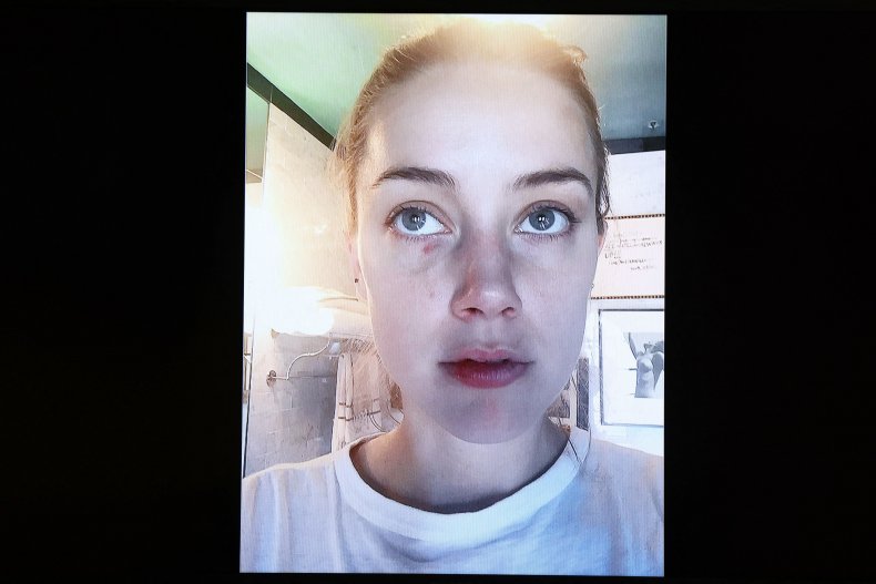 Amber Heard's alleged domestic abuse injuries