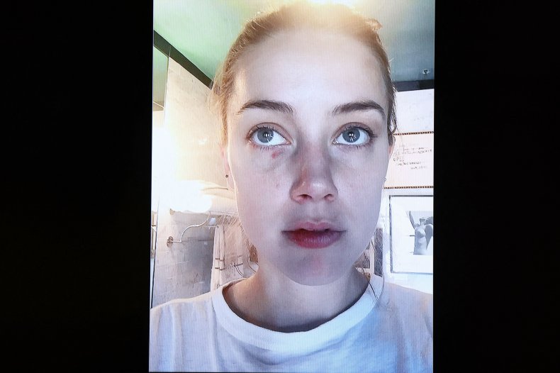 Amber Heard's alleged domestic abuse injuries