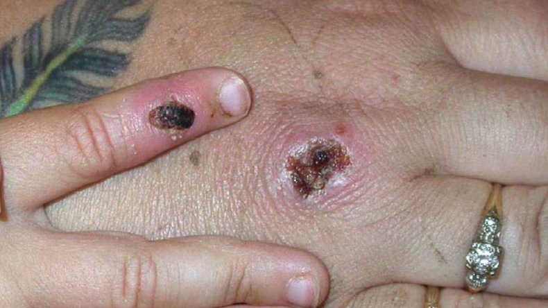 Monkeypox