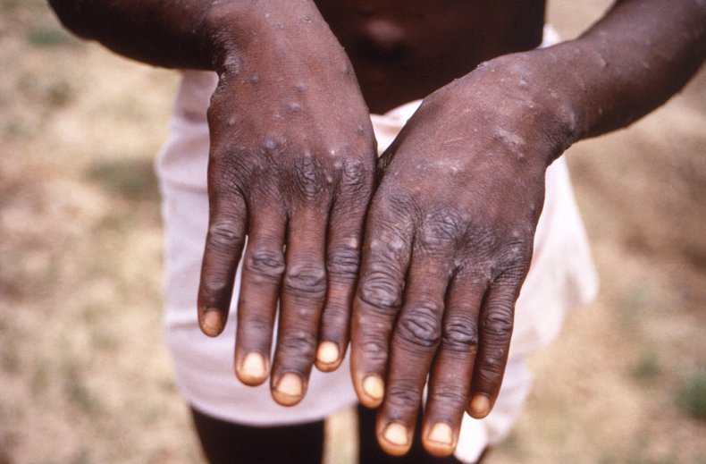 A Close-Up of Monkeypox Lesions