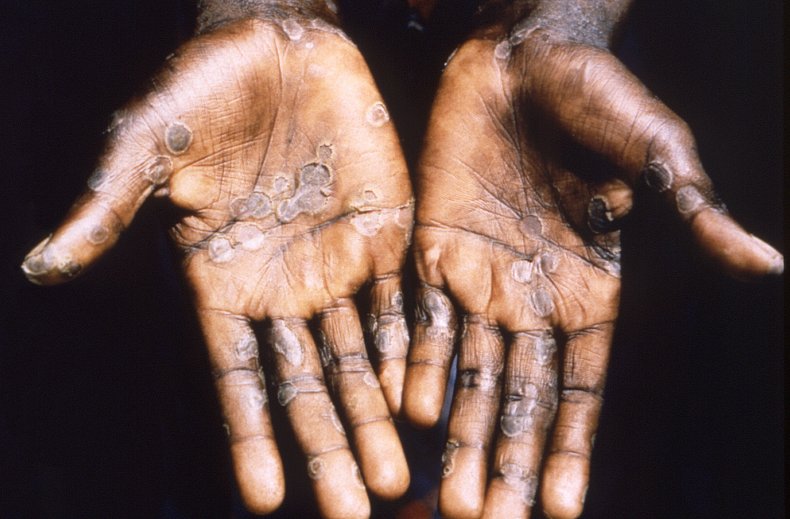 Patient's hands with monkeypox