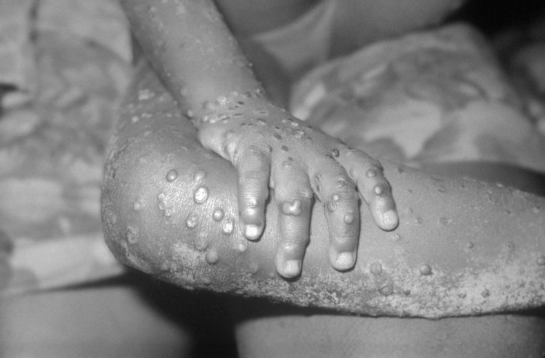 Monkeypox lesions
