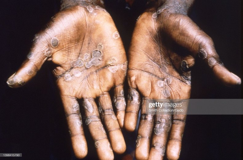 Monkeypox hands disease