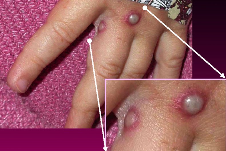 Monkeypox Cases Spread Vaccine Release CDC