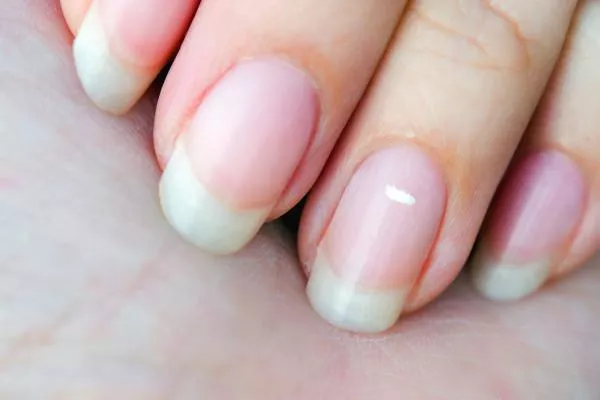 Why Do I Have White Spots on My Nails? Why Do I Have White Spots on My Nails?