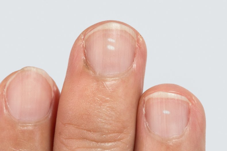 White spots on the nails