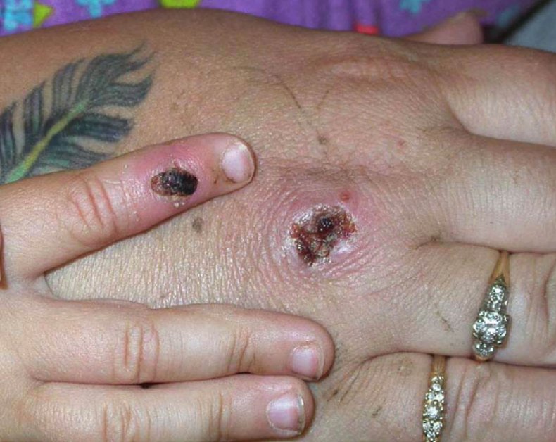 Monkeypox Lesions