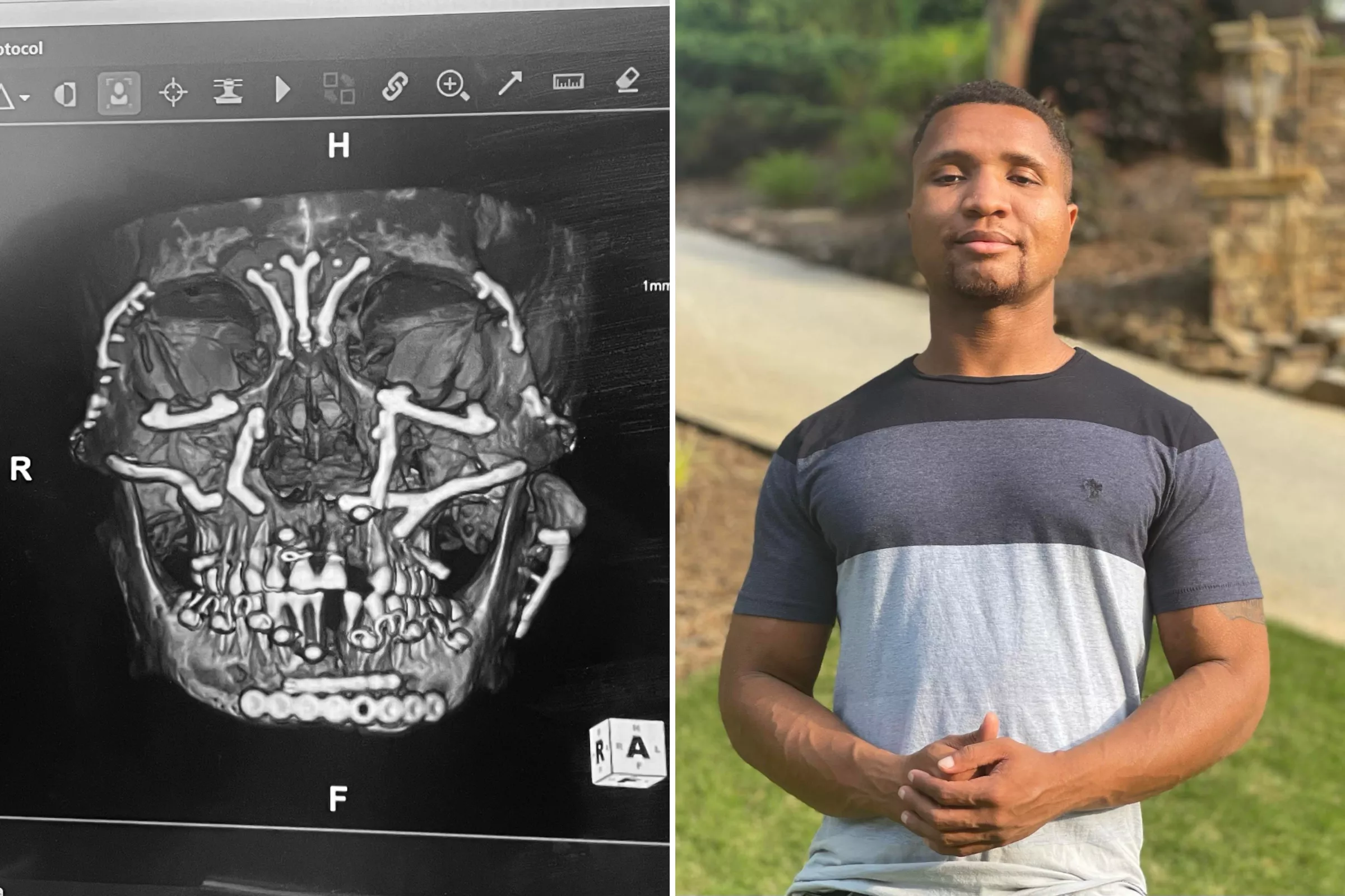 Man With Facial Paralysis Wiggles Eyebrows For First Time, Melts Hearts - Vimarsana News