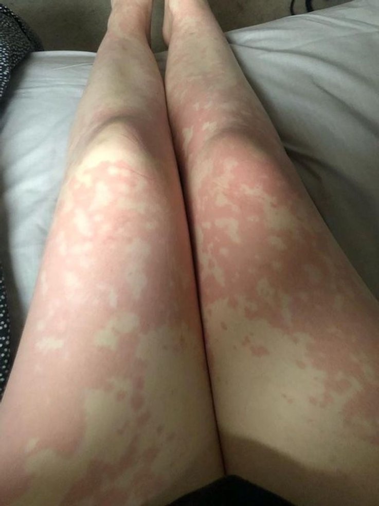 Georgina Masson was diagnosed with acute myeloid leukemia