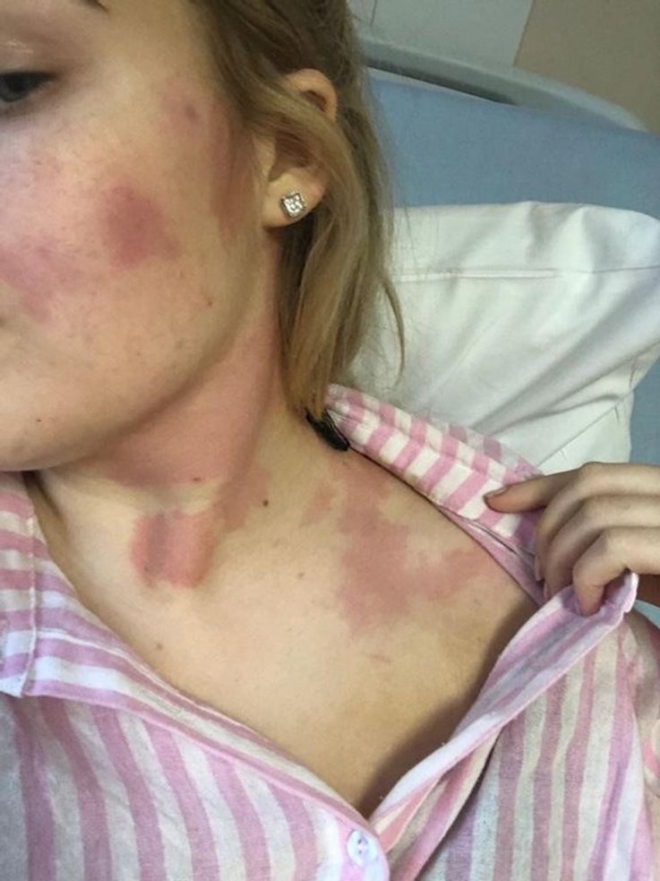 Georgina Masson was diagnosed with acute myeloid leukemia