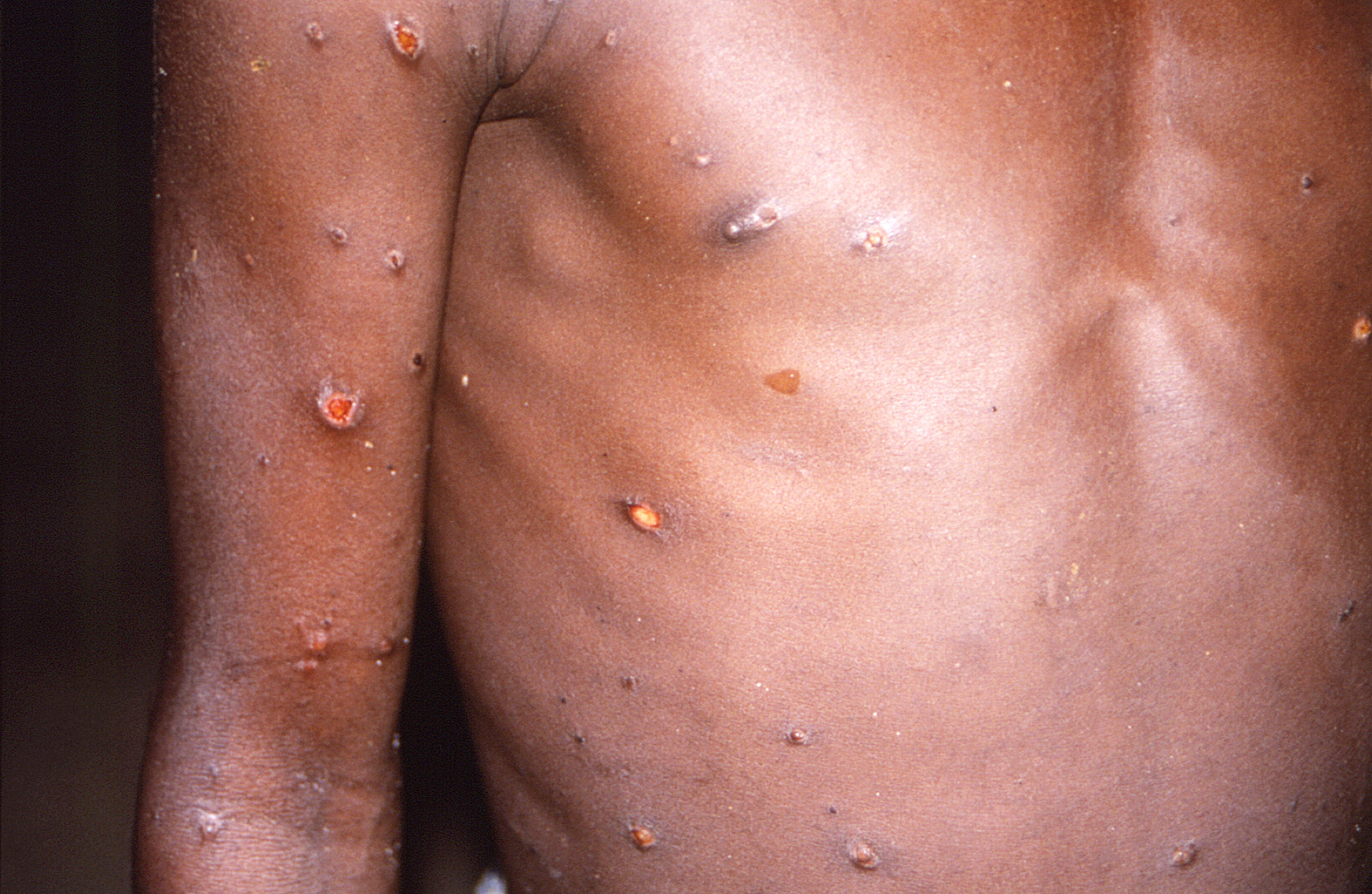Monkeypox Cases in U.S. Primarily Among 