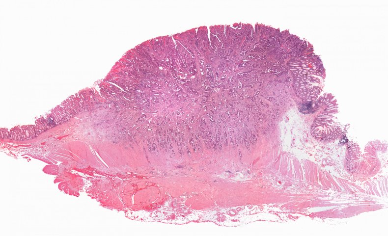 colon cancer cell