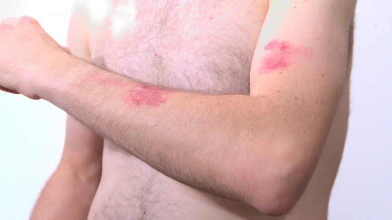 Monkeypox