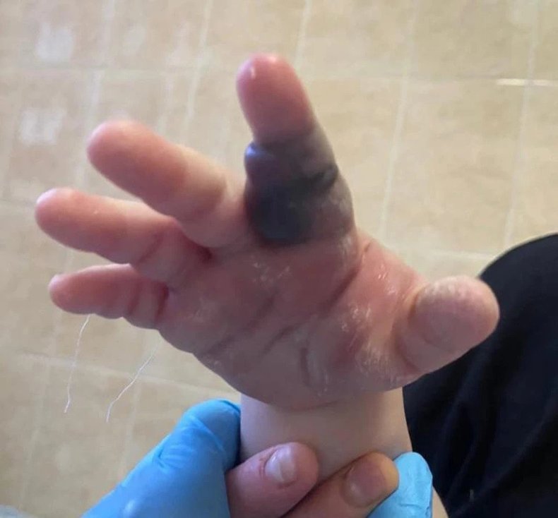 Boy bitten by viper in Russia