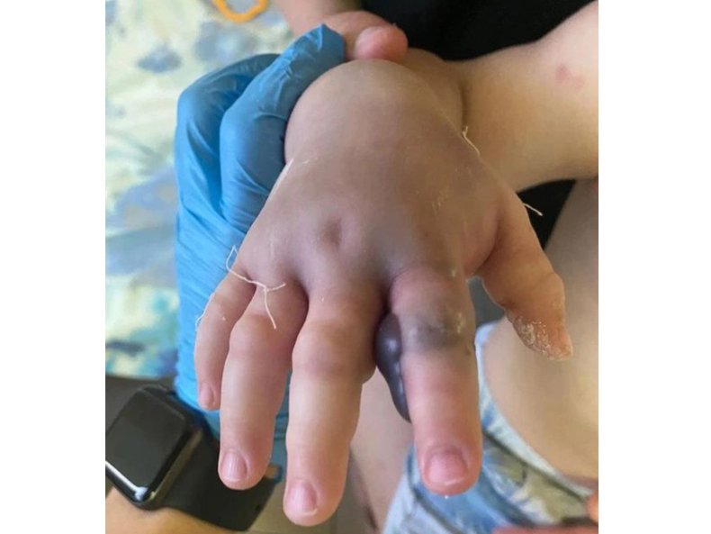Child's finger after viper attack