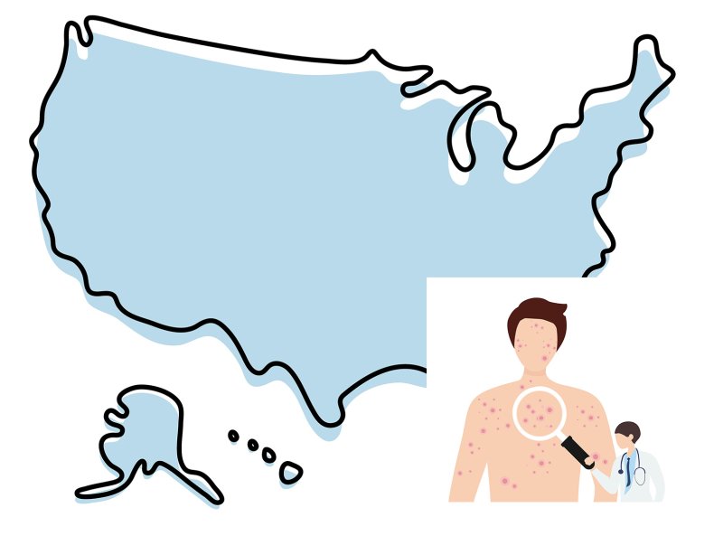 Monkeypox United States 