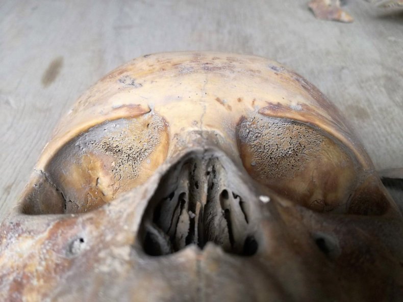 Detail of skull pathology found in Mexico