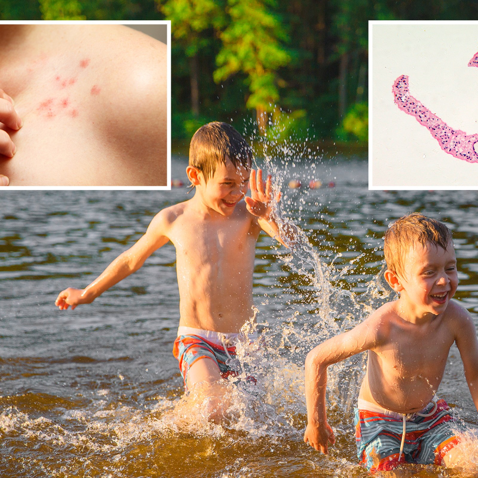 swimmers itch parasite