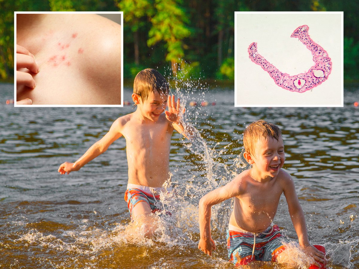 Oklahoma Swimmers Get Covered in Rash After Dip at Lake Eufaula