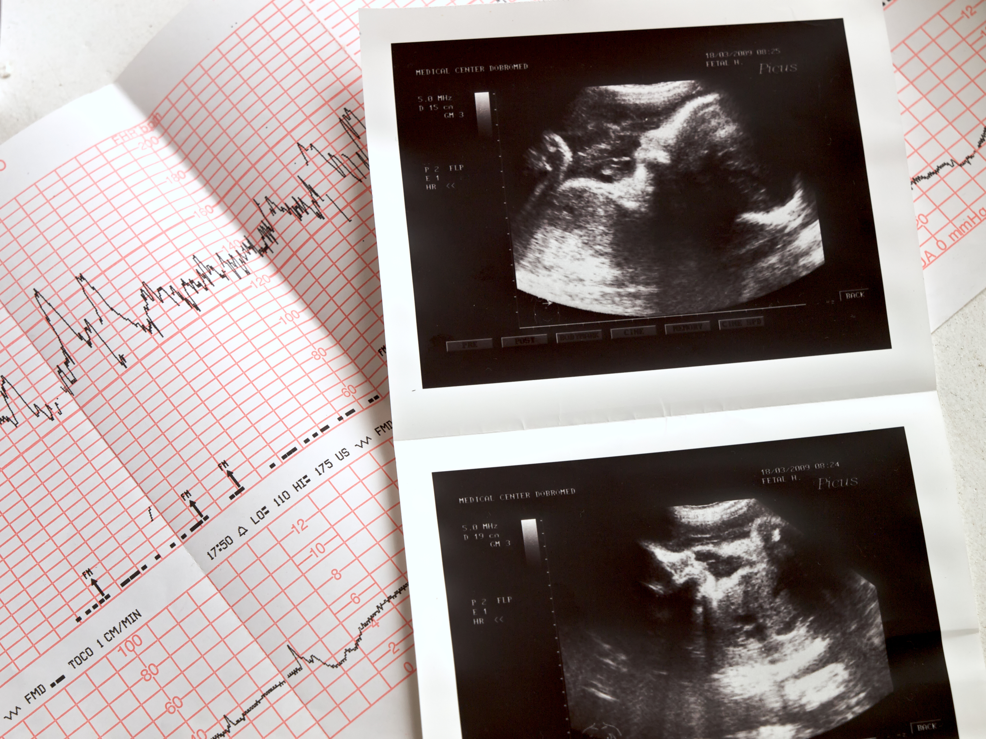 Сердцебиение 14 недель. Снимки УЗИ. УЗИ 1 скрининг. УЗИ КТГ при беременности.