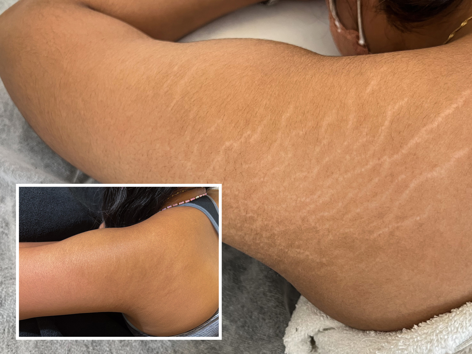 Inkless Stretch Mark and Scar Tattoo Camouflage Treatment  Ink Illusions