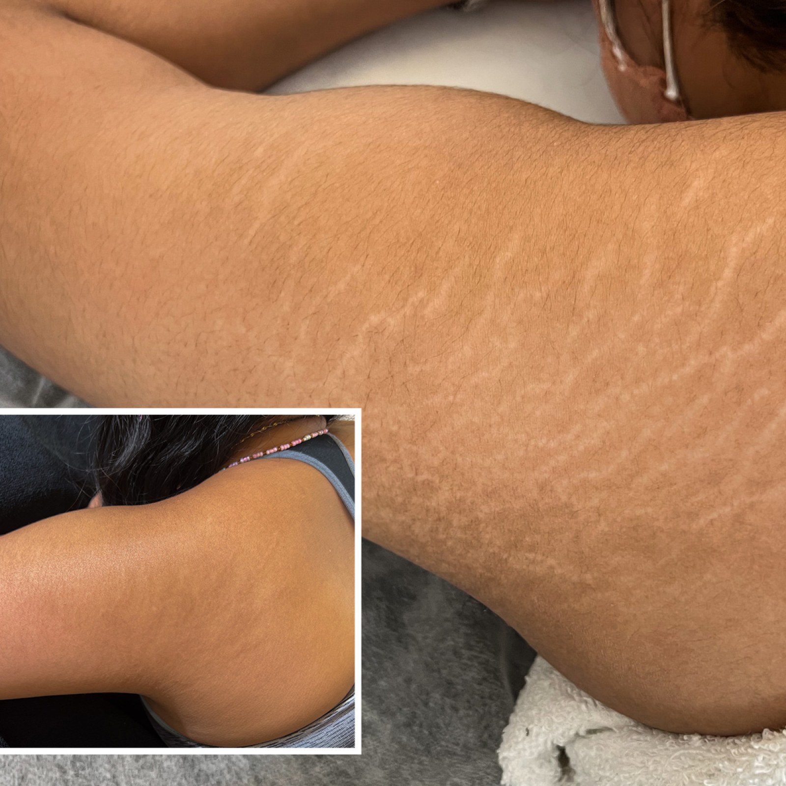 Stretch Mark Removal: How Does It Work And Is It Safe?