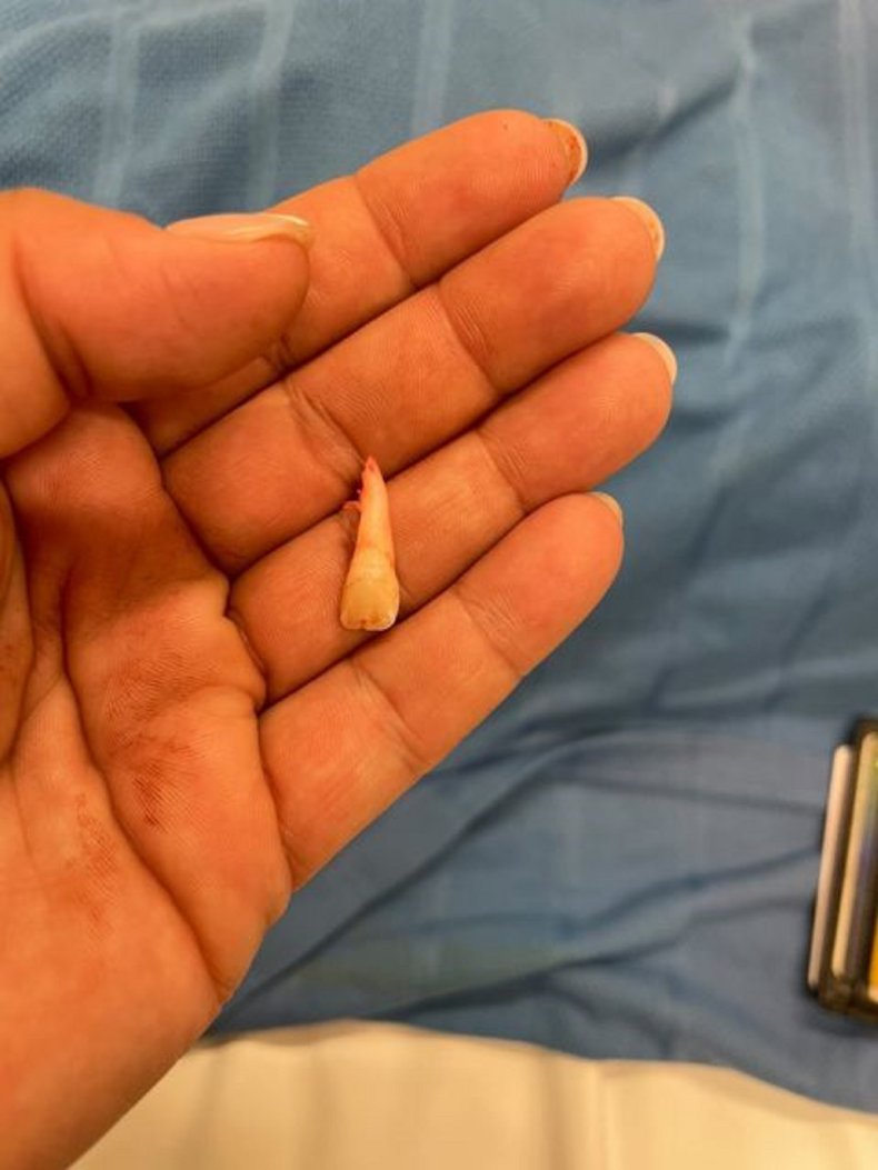 Photo of a lost tooth.