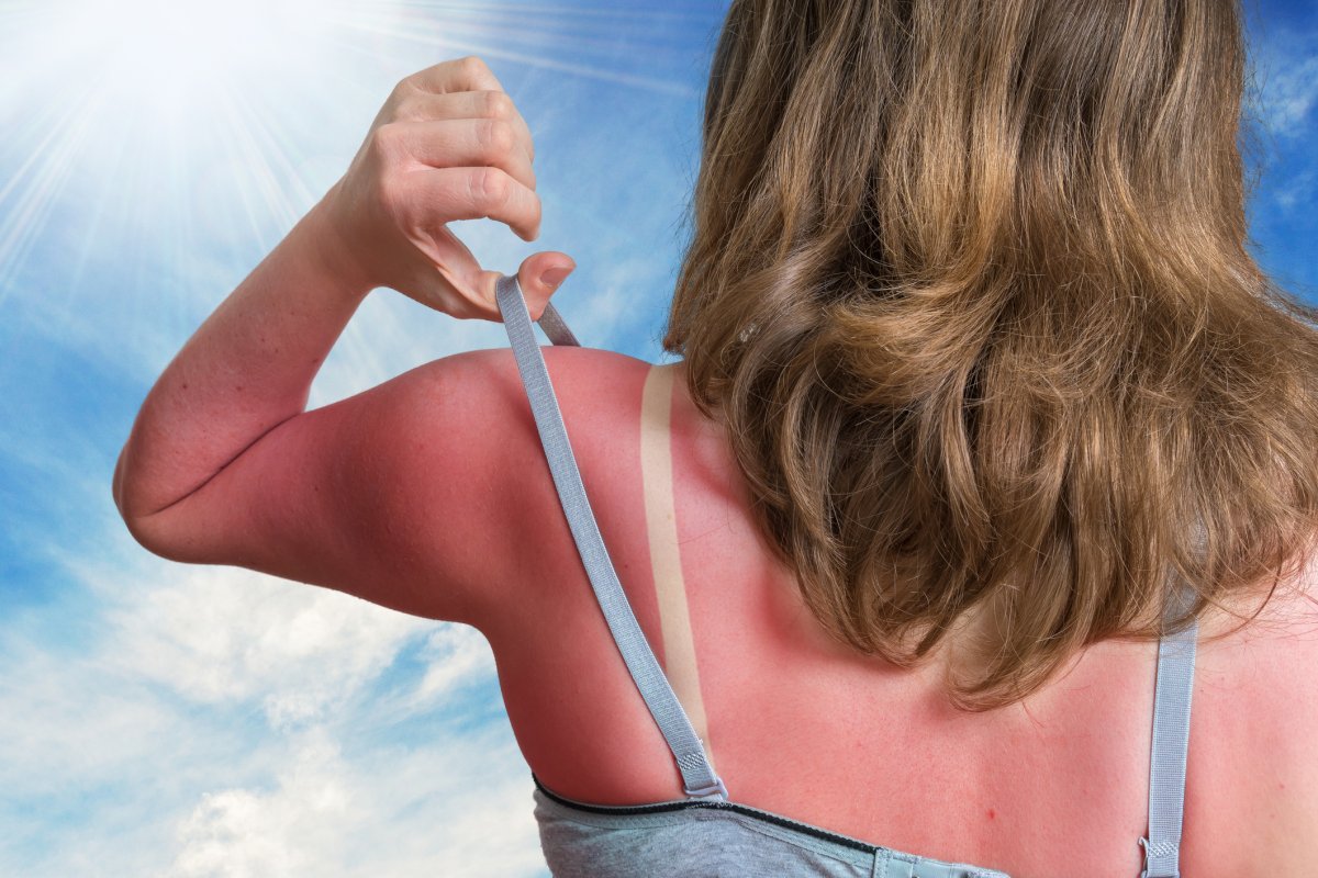 Woman's bad sunburn shocks viewers 