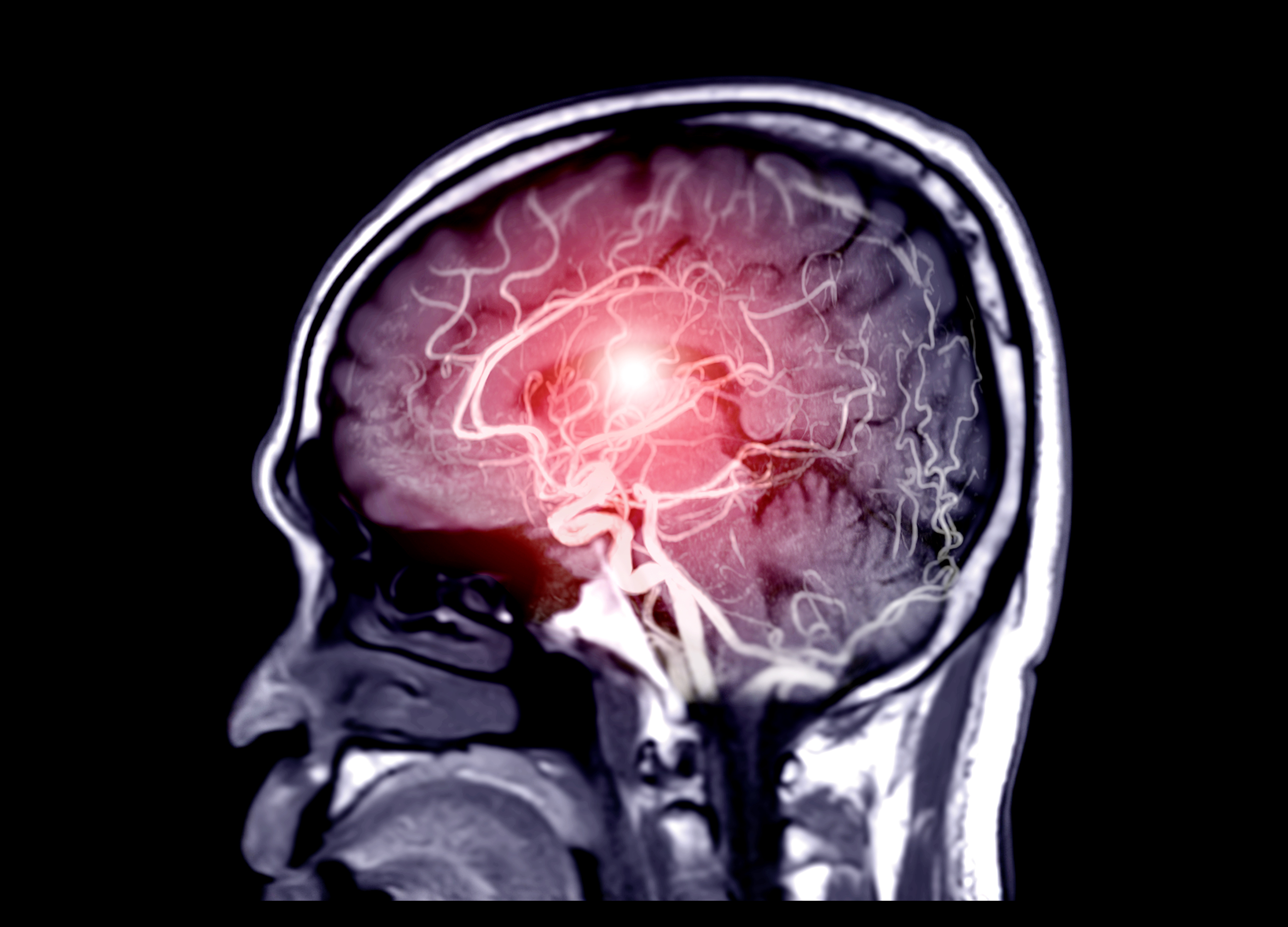 Can A Brain Aneurysm Be Operated On