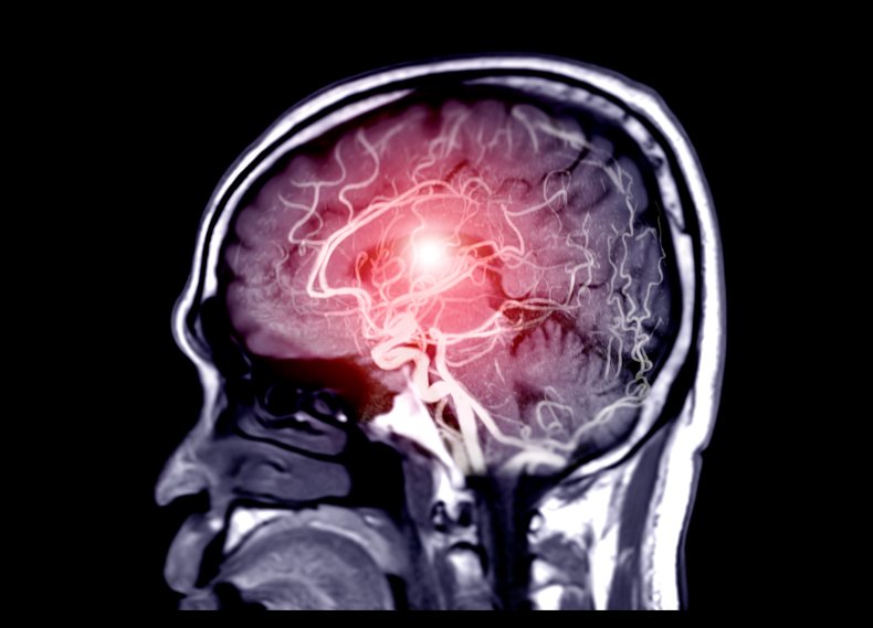 An MRI/MRA brain scan image. 