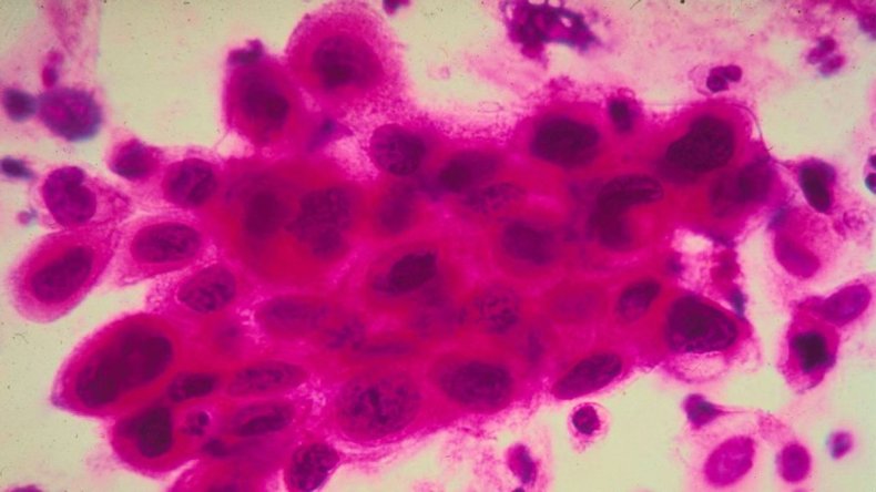 Cervical cancer cells