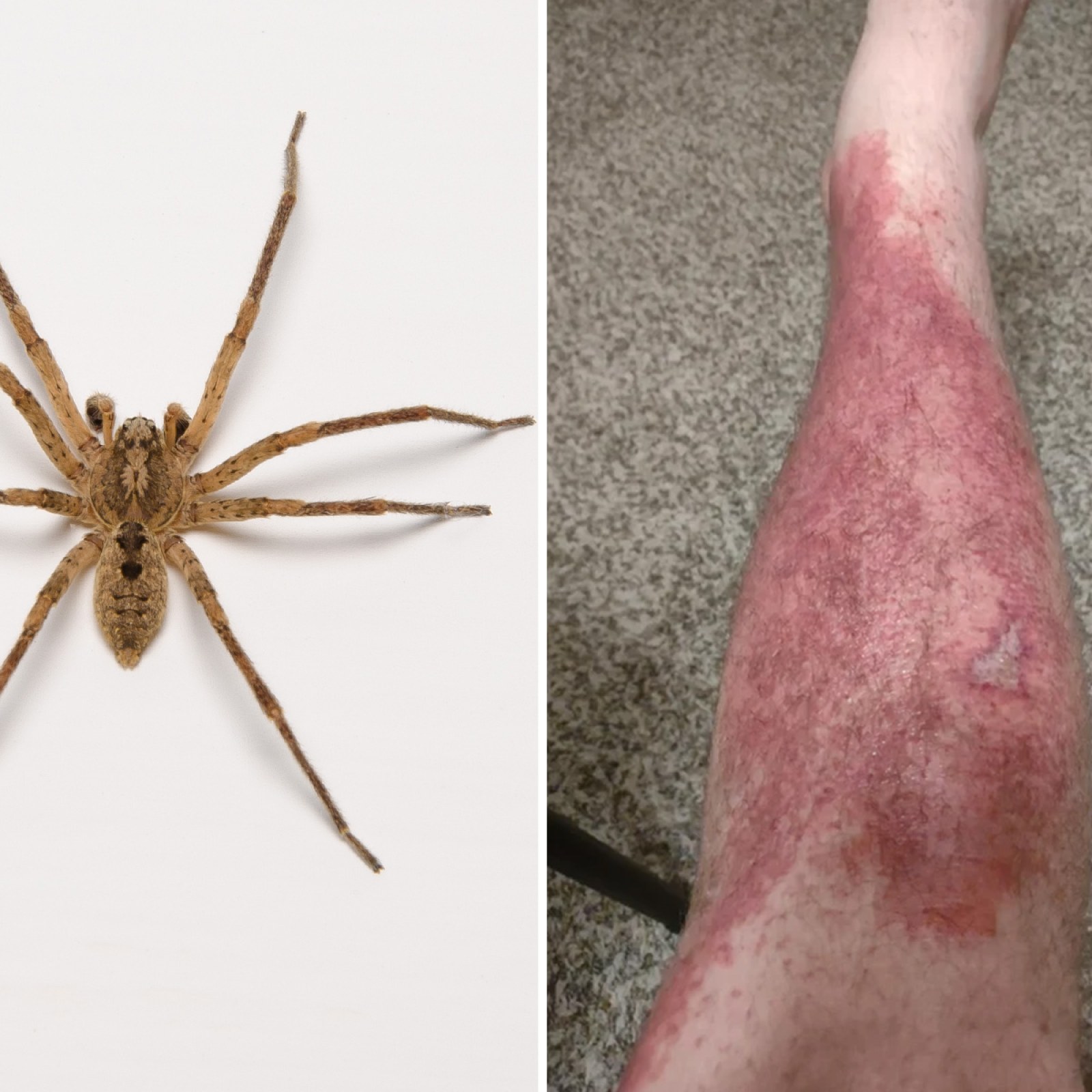Most Dangerous Spider Bites