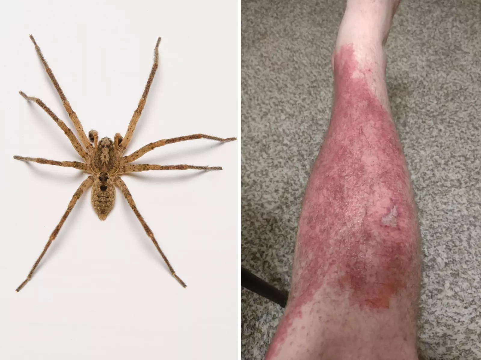 Vaccinere strøm kravle Man Bitten by Spider As He Slept Left in "Immense" Pain, Covered in Rash