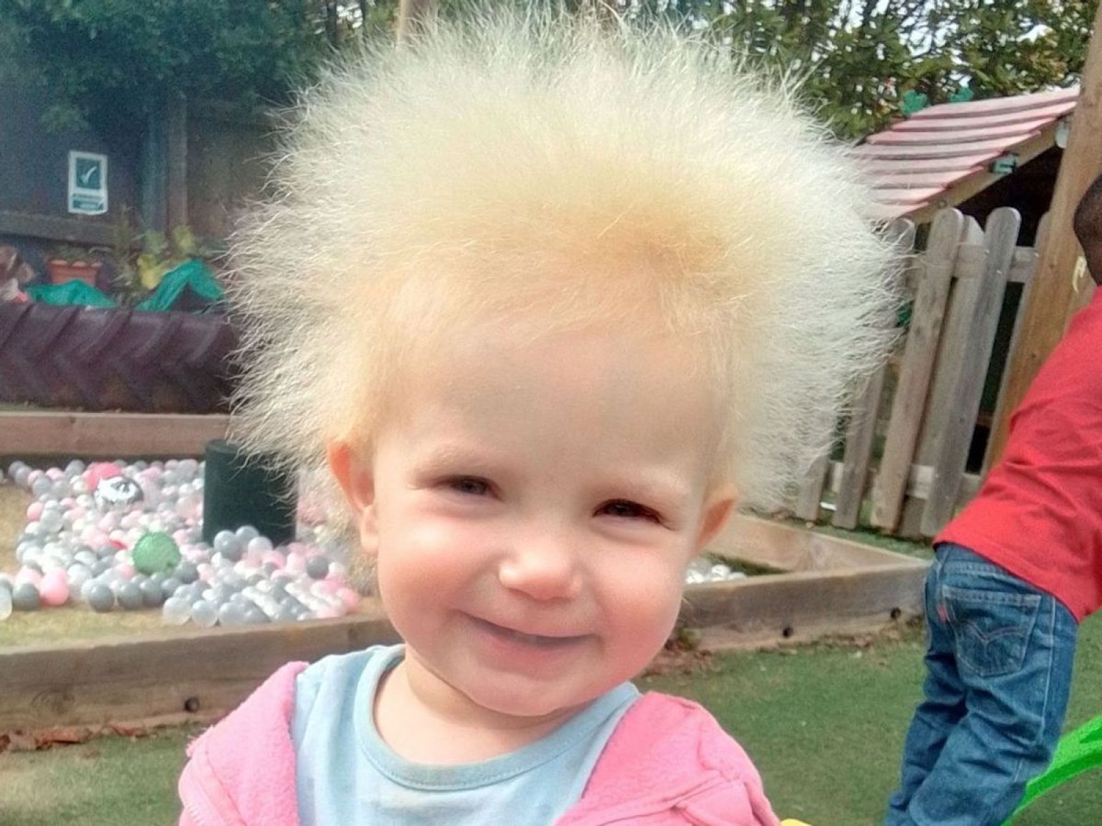 Toddler With Wild Hair Diagnosed With Rare Syndrome