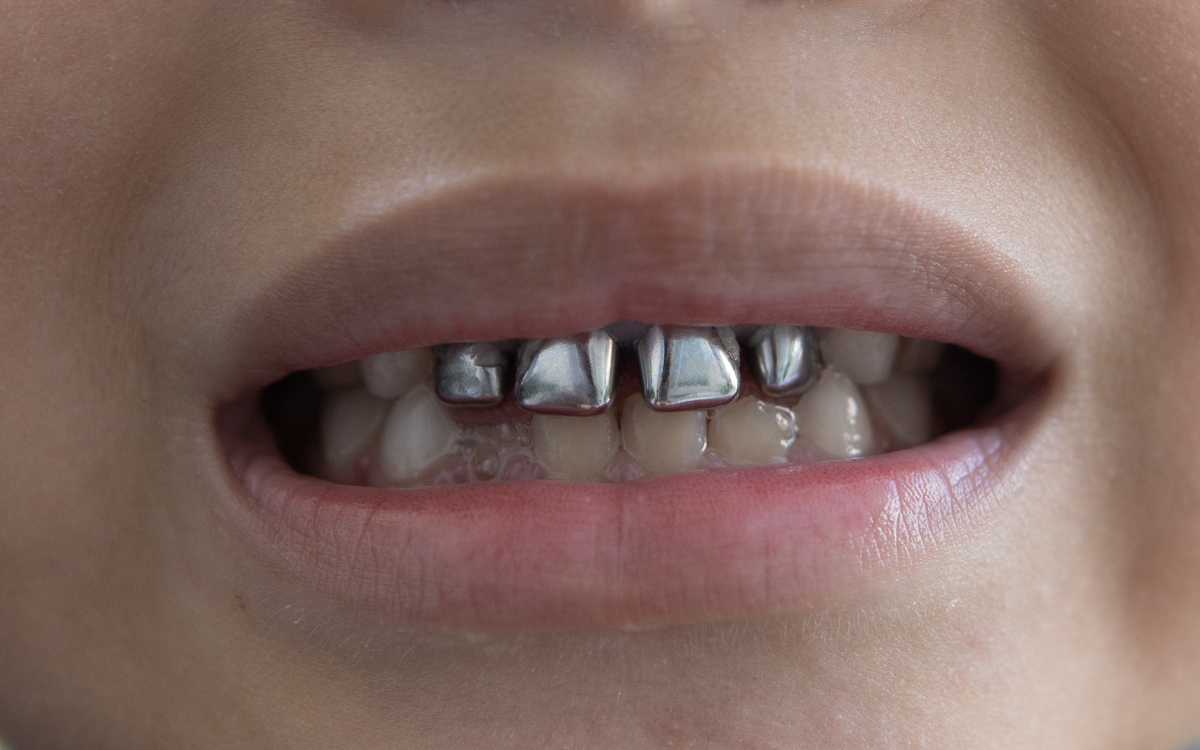 A set of metal teeth.